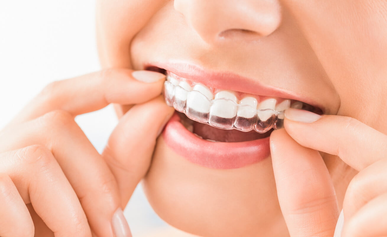  avantajele aparatului dentar invisalign 
